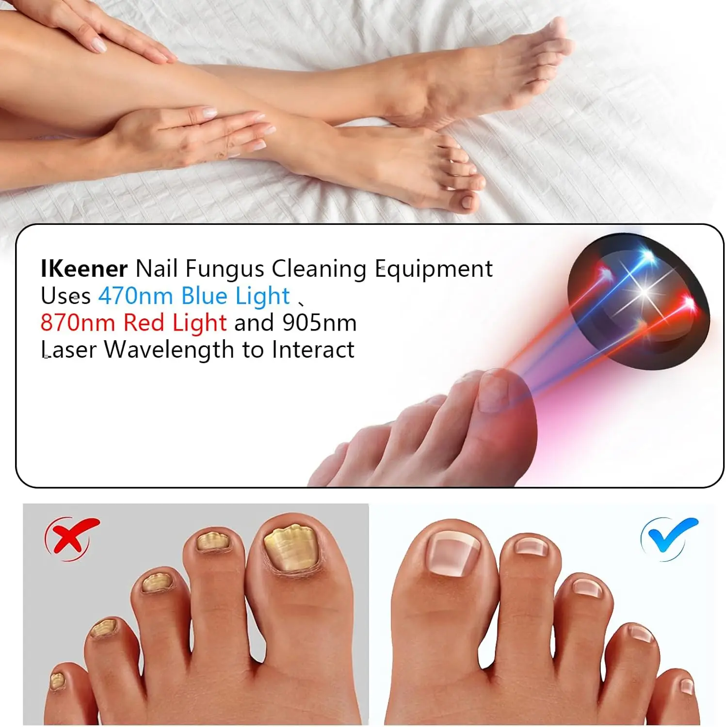 Nagelpilz-Lasergerät mit 470 nm Blaulicht, 660 nm Rotlicht und 905 nm Superpuls-Licht zur intelligenten Entfernung und Reparatur von Nagelpilz._voghion.com