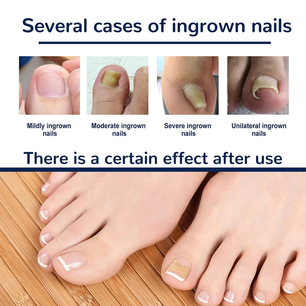 Ingrown Toenail Corrector Patches Nail Correction Care Stickers 50/100pcs,ingrown toenail correction tool,manicure pedicure tool set,foot care tool,foot pedicure tool,foot care patches,toe corrector