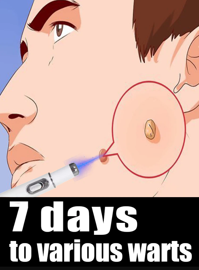 Outil Wart Blue Light, plus de réductions sur les ensembles