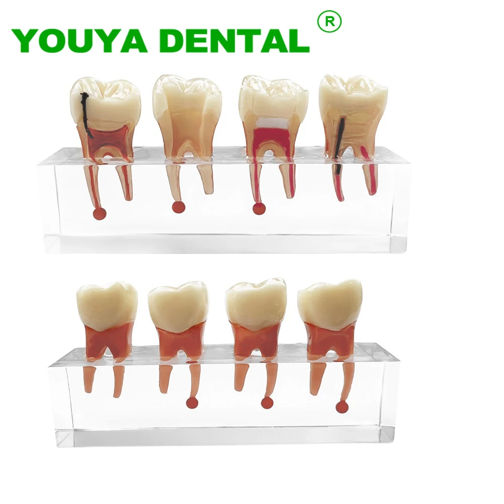 Model zębów dentystyczne endodontyczne leczenie próchnicy przejrzysty ...