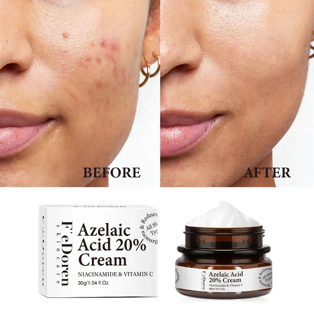 Azelaic Acid 20 Facial Cream Remove Dark Spots Acne Fine Lines Whiten