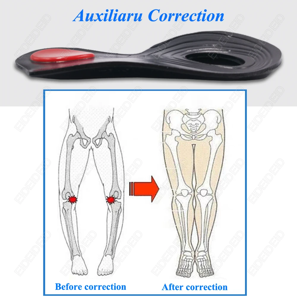 1–2 Paar orthopädische Einlegesohlen zur Unterstützung des Fußgewölbes, Plattfüße, Fersenschmerzlinderung, X/O-Typ, Beine, Valgus-Fußkorrektur, Schuhpolster für Damen und Herren – Detail 4