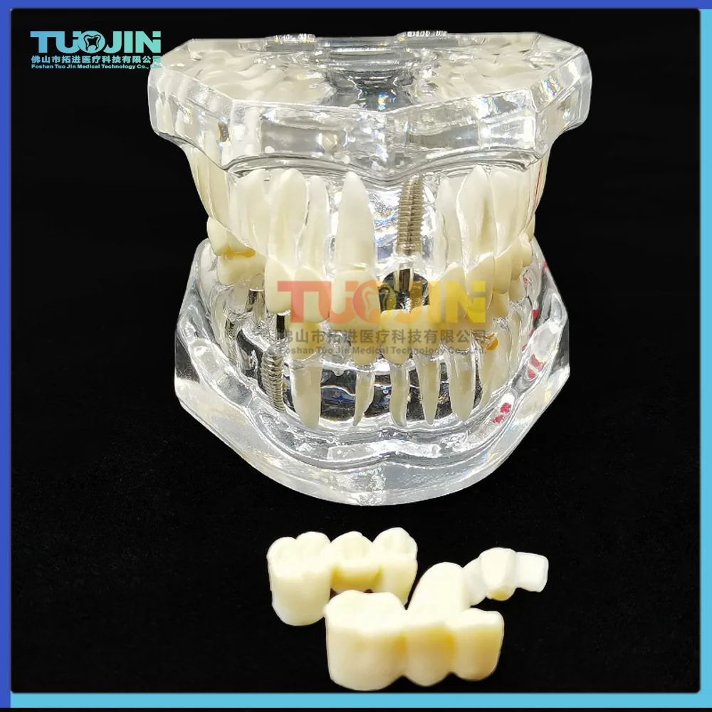 Tanio Przezroczysta choroba Model zębów Implant dentystyczny Model zębów dentysta