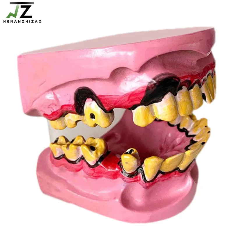 

Smokers Tooth Decay Smoking Pathology Teeth Model