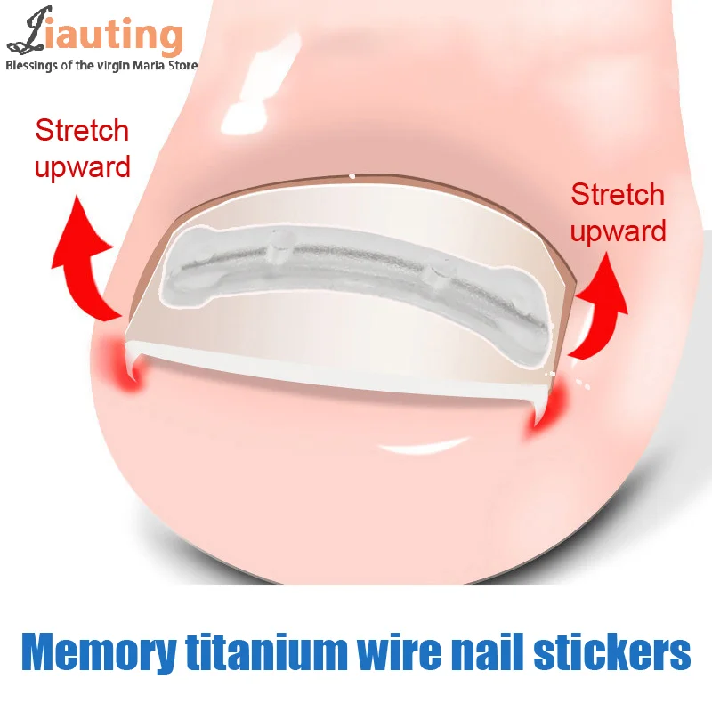 

25/30Pcs 13-19mm Ingrown Toenail Correction Tool Nail Treatment Toe Foot Care Pedicure Foot Orthodontic Toe Thumb Nail Patches