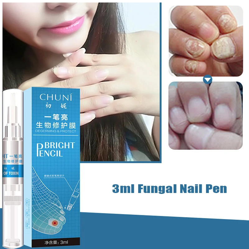 3ml Fungal Nail Pen Effective Onychomycosis Paronychia Fungus Infection