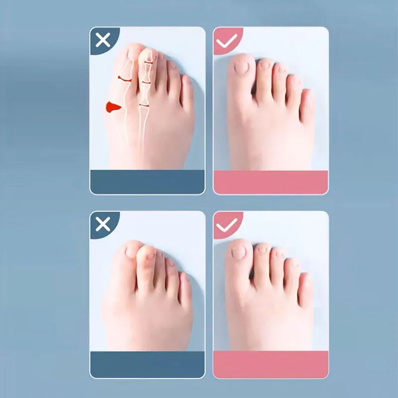 2Pc Silicone Toe Separator Fingers Feet Toe Spreader Hallux Valgus Bunion Corrector Straightener Corrector Finger Separators