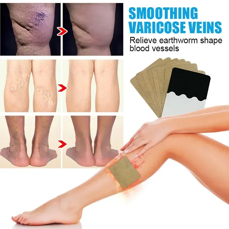 Varicose Veins Patch 6/8pcs Vascular Veins Remover Spider Legs Treatment Chinese Medical Plaster Angiitis Stickers Skin Care varicose veins patch