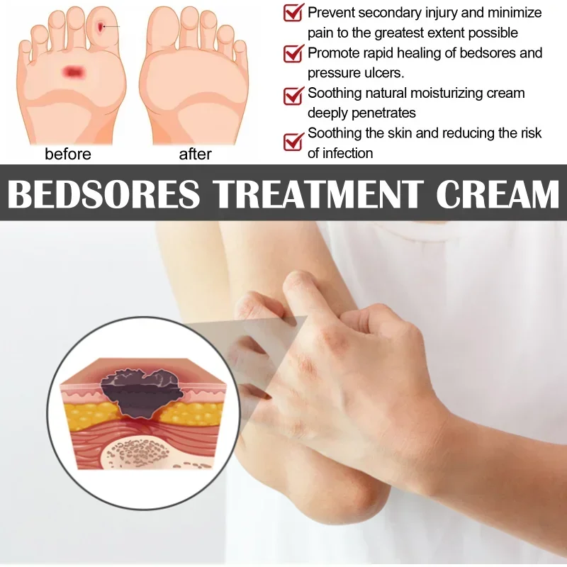 Decubitus Cream Pressure Sore Ulcer Skin Relief Ointment Bed Sore Wound Healing Treat Anti Dry Repair Moisturizing Body Care sore healing cream