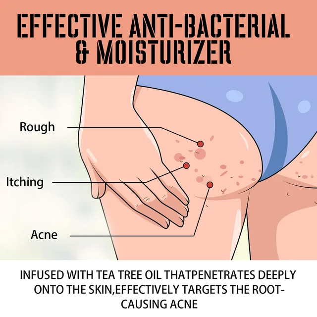 Crema per il trattamento dei glutei A-cne Rimuovi l'acne dell'anca Pim-ples Pelle liscia Anti prurito Prevenire l'intasamento dei pori Crema sbiancante per la cura dei glutei 3