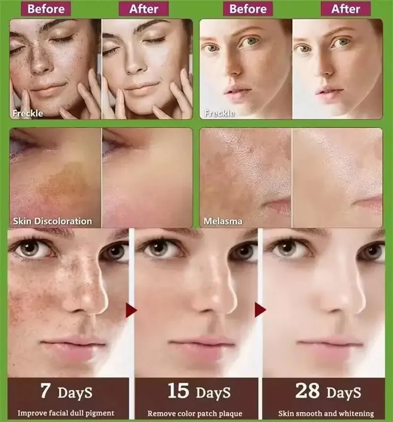 Facial Serum Whitening Serum Spot-removing Brighten Skin Eliminates Melanin Pigmentation Melasma Dark Spots Moisturize