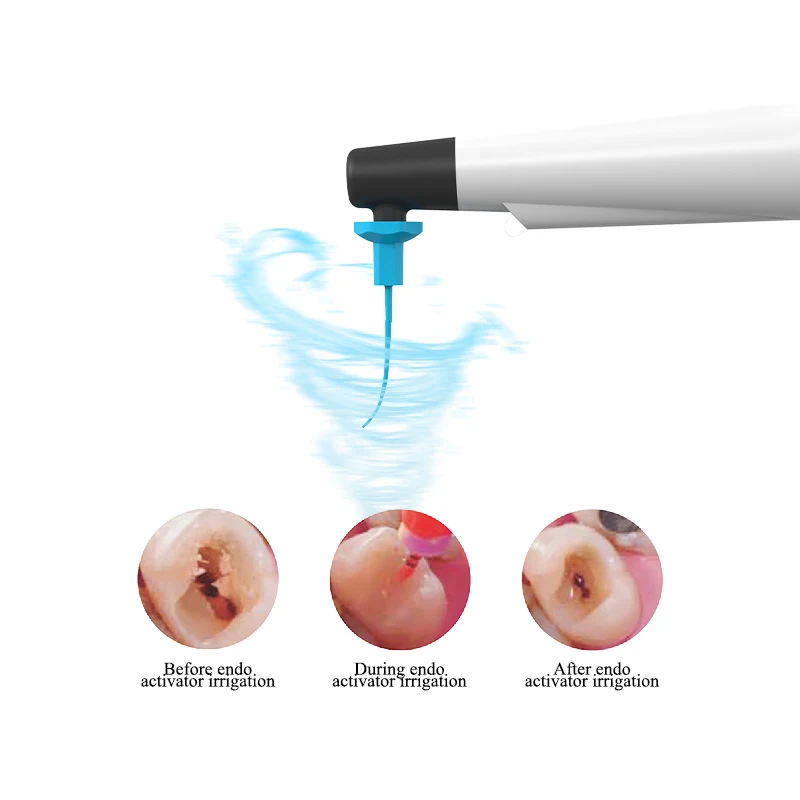 

Beling Dental Sonic Irrigator Endodontic Treatment Cordless Handpiece with 3 Size Activator Tips for Surgery Root Canal Tool