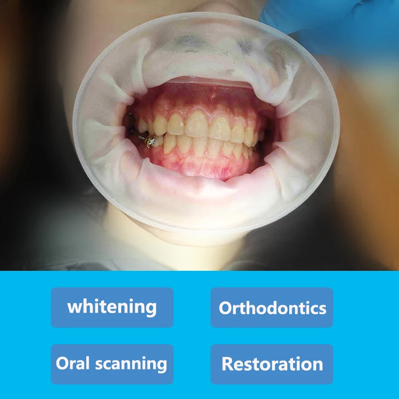 5/10/20Pcs Dental O Shape Mouth Opener Cheek Retractors Orthodontic Oral Lip Cheek Retractor Expander Teeth Whitening Dentistry 2