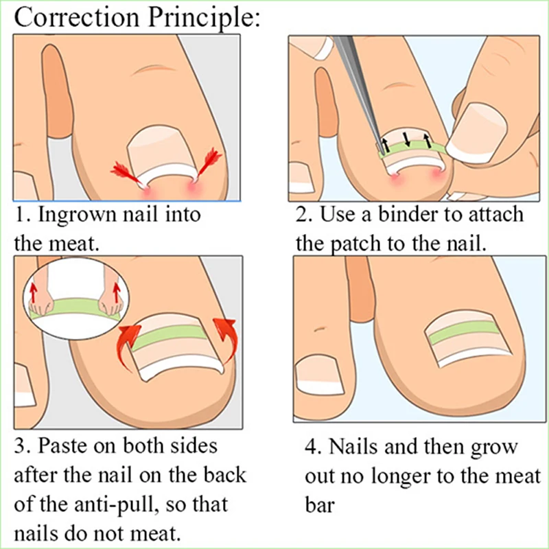 alt="The Nail Correction Stickers for Ingrown Toenail Treatment, 10Pcs in sizes 13-20mm.