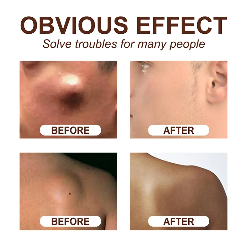 Treatment Lipoma Cream Subcutaneous Lumps Remover Medicine Liquid Apply To Skin Swelling Cellulite Fibroma Fat Mass Plaster