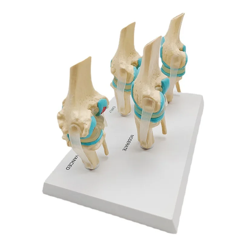 Four-stage Human Pathological Knee Joint Anatomy Model Medical Science Teaching Resources