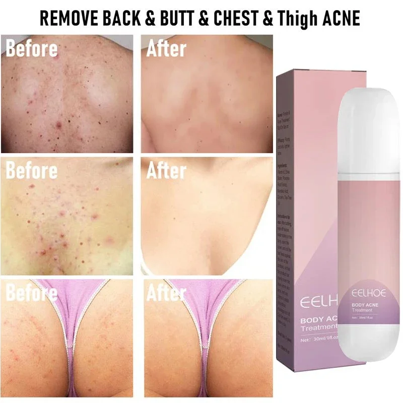 

Acne Treatment Rolling Ball Remove Neck Chest Back Hip Acnes Relive Fade Acne Marks Inflammatory Smooth Skin Body Care Serum