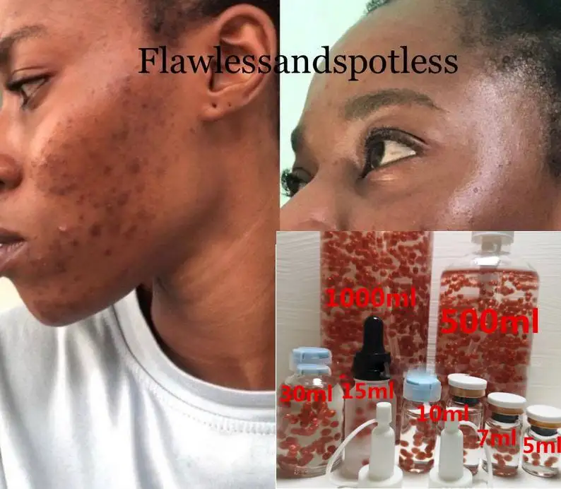 Acne Dark Spots Remover Acne dark spots remover