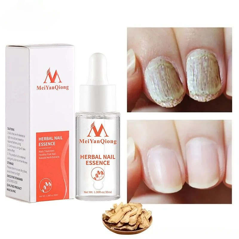 Toenail Repair Essence Anti Infection Nail Fungus Treatments Essence Feet Onychomycosis Repair Supply Unisex