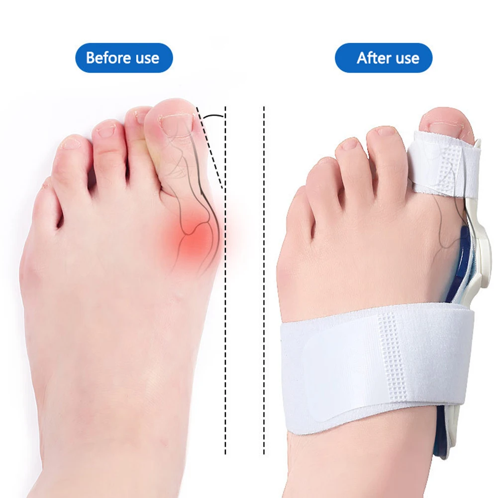 Adjustable Orthopedic Bunion Corrector for Big Toe Relief