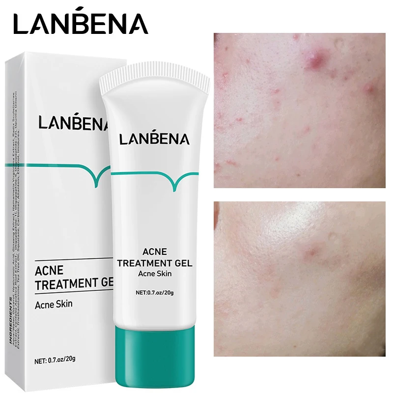 

LANBENA Acne Treatment Gel Fade Acne Marks Shrink Pores Repair Cream Anti-Acne Oil Control Moisturizing Nourish Face Skin Care