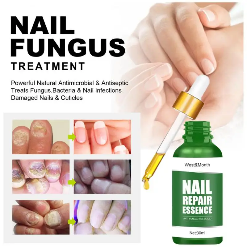 How To Stop Nail Biting: After 20 Years, This Is How I Finally Broke My  Biting Habit | 10/30ml Nail Repair Solution Inner Growth Toenail Repair  Serum Clean And Remove Grey Nails