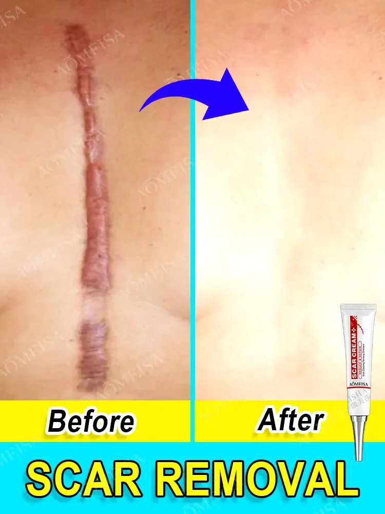 

ACNE SCARS,SURGICAL PRINT,SCARS HYPERPLASIA,STRETCH MARKS,BURNS AND SCALDS,SCAR ATROPHY