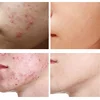 Crème Anti-acné à base de plantes, Gel pour le visage, Anti-acné, cicatrice, contrôle du sébum, élimine les boutons, blanchissante, hydratante, soins pour le visage