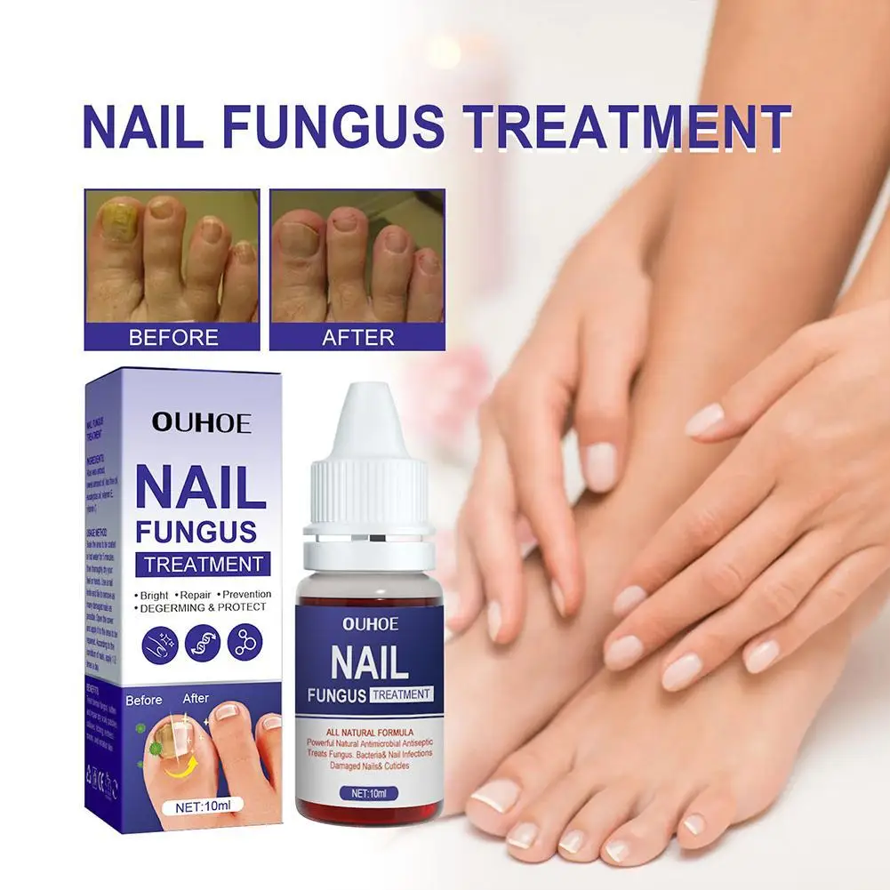 

10ml Repair Nail Fungus Treatments Essence Foot Care Serum Toe Nails Fungal Removal Gel Anti-Infection Onychomycosis