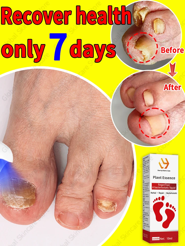 [Limited Time Offer] Repair Serum: Powerful Treatment for Fungal Infections and Toenails