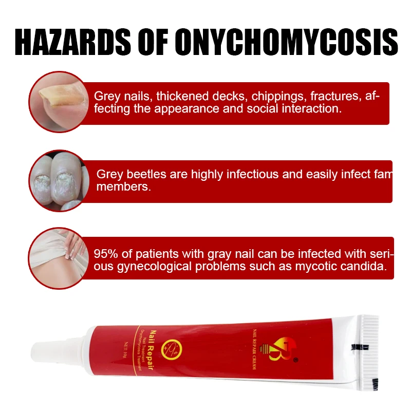 

3Pcs 10g Nail Fungal Ointment Foot Toe Nail Fungus Removal Cream Paronychia Onychomycosis Feet Care Antibacterial Dressing