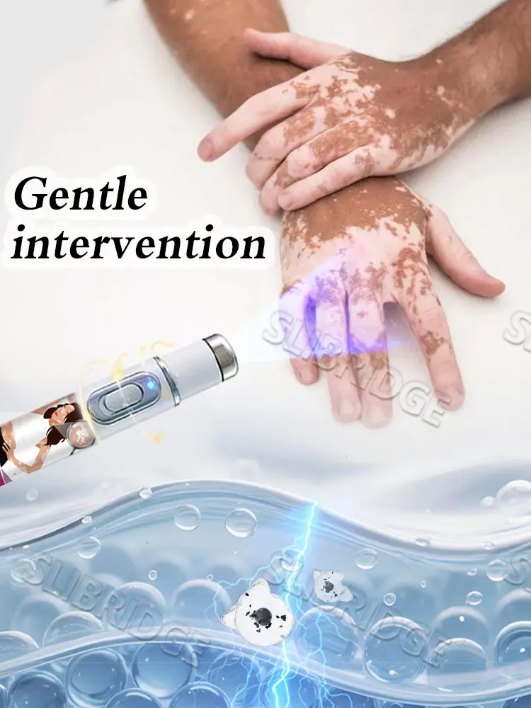 Penna a luce blu di seconda generazione (2025): strumento per risolvere il problema della vitiligine._voghion.com