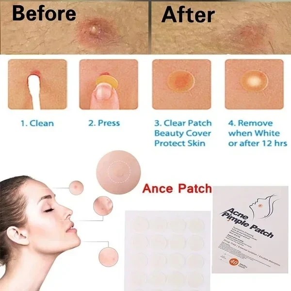 24pcs Face Acne Pimple Spot Facial Skin Care Blackhead Removal Freckle Patches Scar Care Treatment Stickers Acne Mask Beauty 3