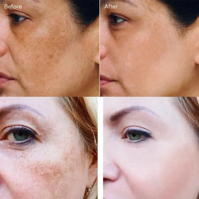 Dark Spots Remover Whitening Face Set Freckle Melanin Correcting Reduce Fine Lines Brighten Essence Korean Beauty Skin Care