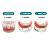 Dental Teeth Model with Implant Overdenture Inferior Demo Mandibular Model Dentist Student Learning Model 1