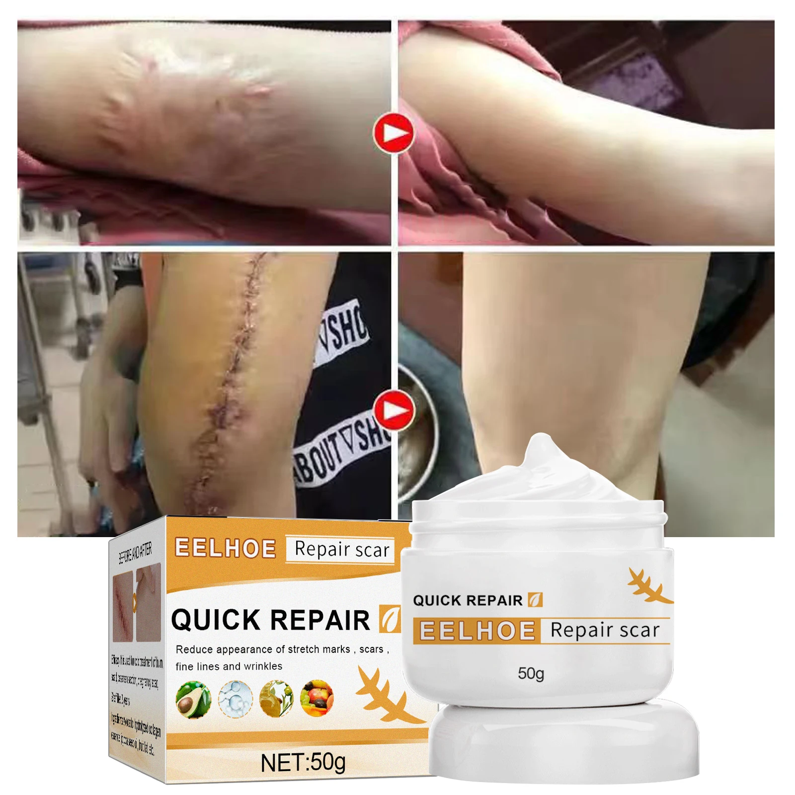 

Scar Removal Cream Repair Burn Surgery Skin Treat Gel Keloids Acne Pox Prints Burn Moisturizing Ointment Smooth Skin Care