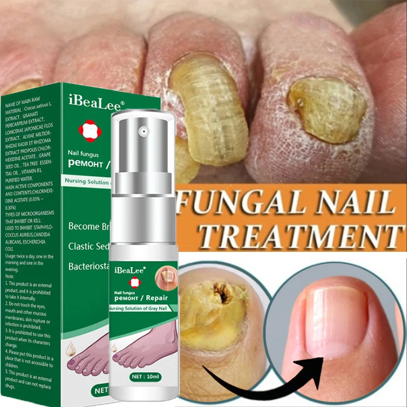 Siero-per-il-trattamento-dei-funghi-delle-unghie-Anti-infezione ...