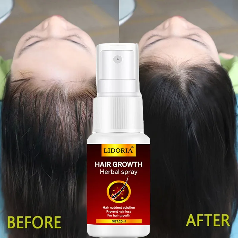 Hair Growth Serum Spray Fast   Liquid Treatment Scalp  Follicle Anti  Loss Natural Beauty Health  Care