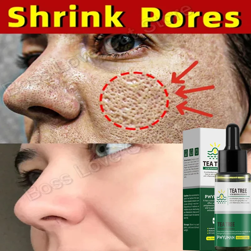 Pore Shrinking Serum Fast Acne Removal Essence Tea Tree Extract Facial Pimples Zits Spots Acne Treatment Deep Cleaning Moisture pore shrinking serum cleaner remover open pores face cleaning contraction minimizer facial cleansing