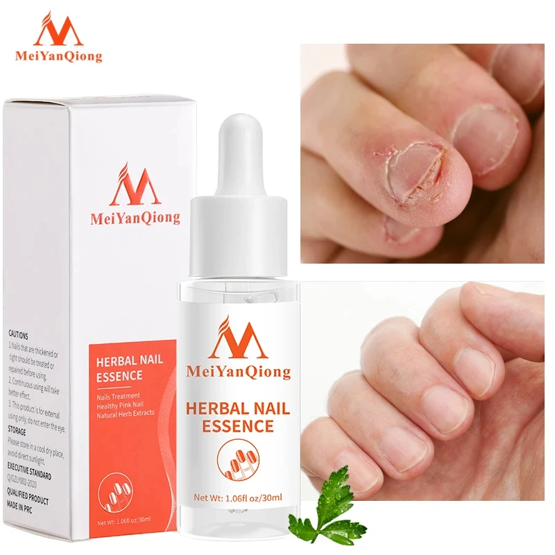 

Nail Treatment Feet Care Essence Nail Foot Whitening Toe Nail Fungus Removal Gel Anti Infection Nails Repair Oil Health Beauty