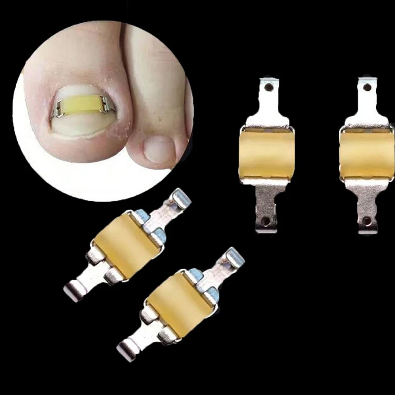 

Ingrown Toenail Corrector Tools Recover Embed Toenail Treatment Pedicure Professional Ingrown Toenail Correction Foot Care Tool