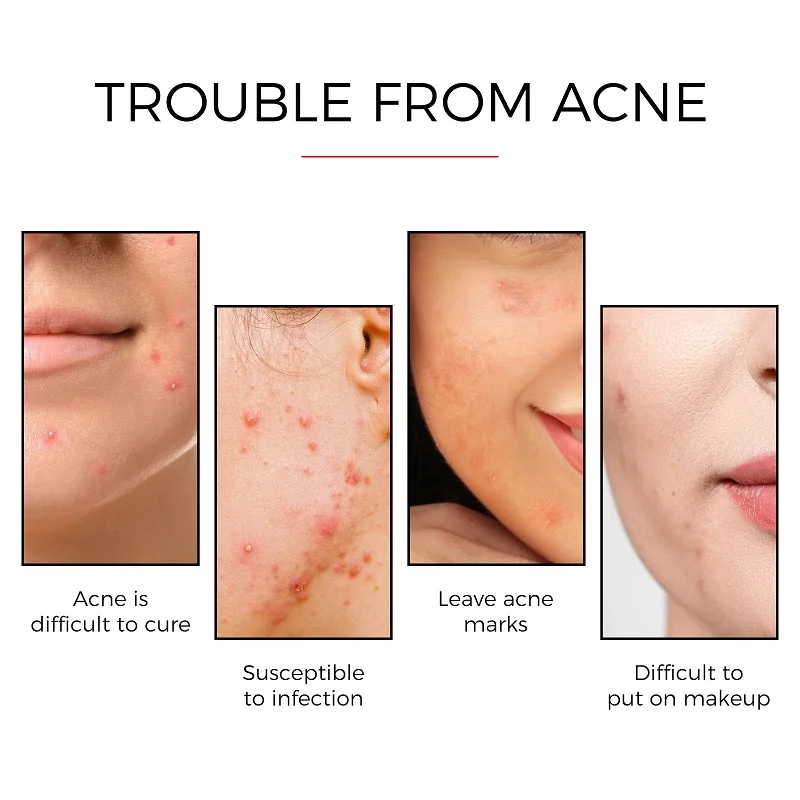 24pcs Face Acne Pimple Spot Scar Care Treatment Stickers Facial Skin Care Blackhead Removal Freckle Patches Acne Mask Beauty 4