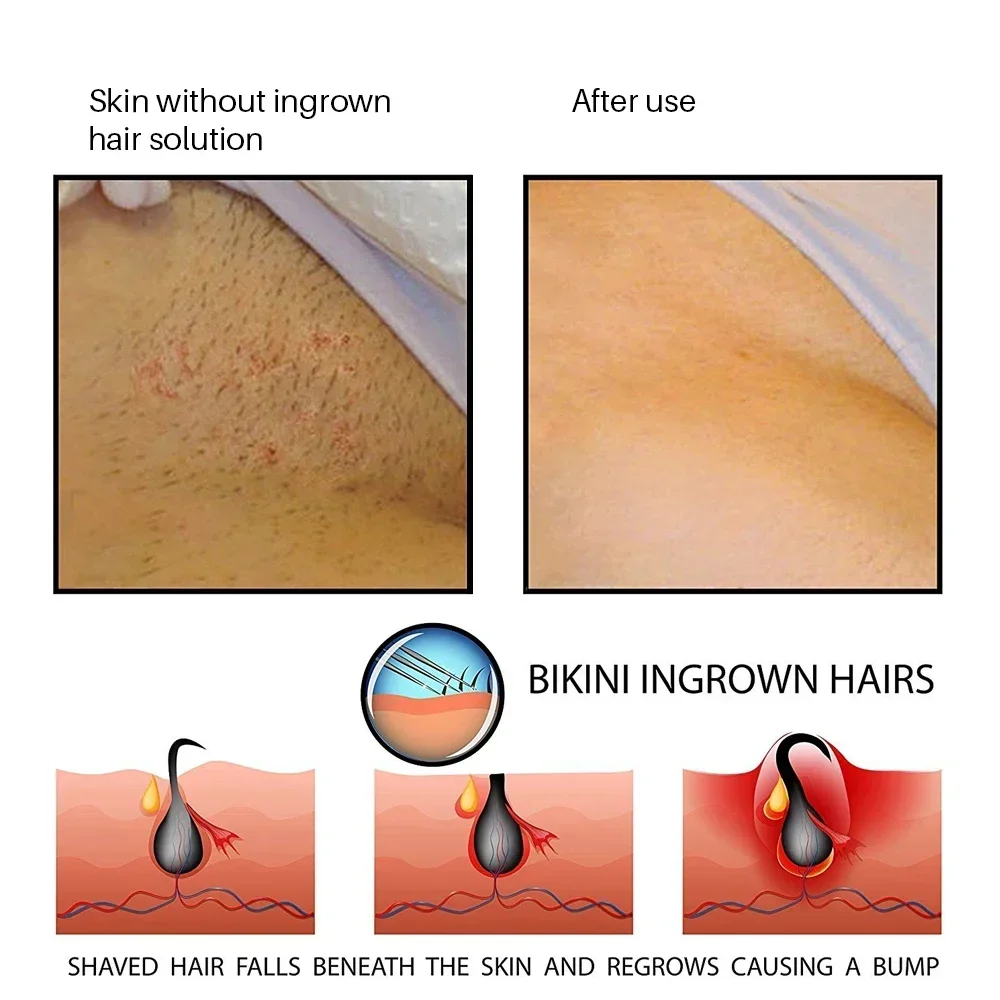 Prevent Ingrown Hairs Treatment  After Shave Lotions blam for Men Repair Dark Spot Serum Reduce Redness Moisturizes Solution images - 6