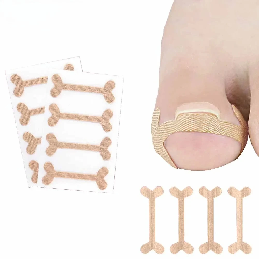 20-100pcs Ingrown Toenail Corrector Stickers Paronychia Treatment Pedicure Toe Nail Care Corrector Patch Correction Stickers