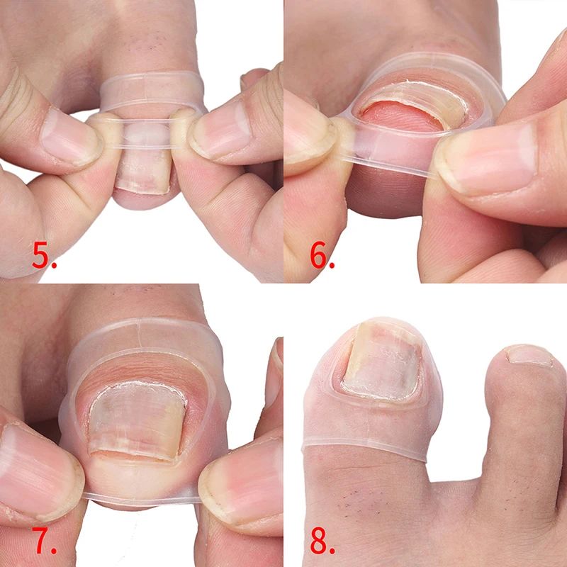 

Silicone Ingrown Toenail Correction Tool Invisible Ingrown Toe Nail Treatment Elastic Straightening Clip Brace Pedicure Tool 2pc