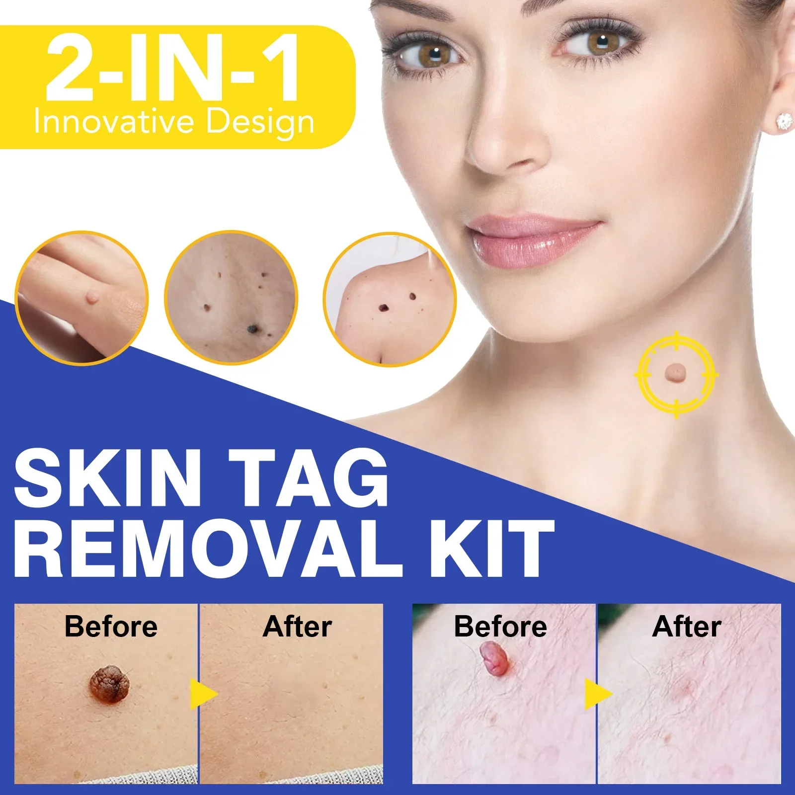 2-IN-1 Wart Removal Kit Meat Polka Dots Warts Acne Flesh Mole Face Pot Fast Removal Kit Unisex Body Skin Tag Care Tools