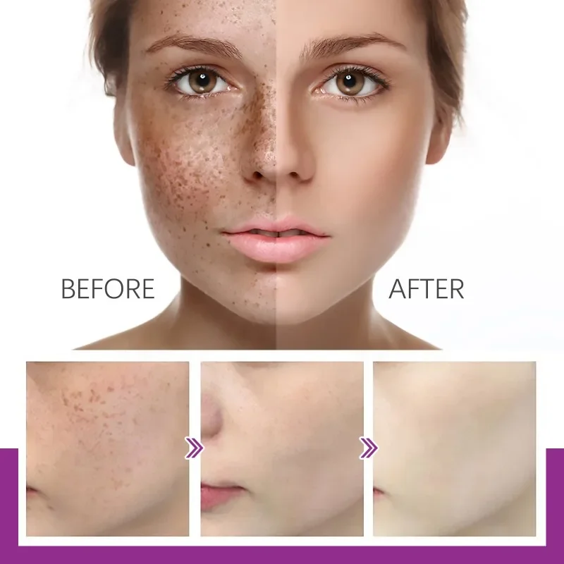 

Sdottor New Whitening Freckle Cream Removal acne marks Dark Spots fade Melasma Melanin repair Dull Moisturizing firming Brighten