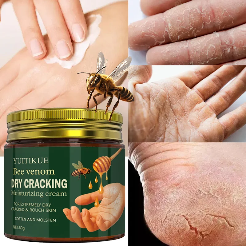 Bee venom dried crack moisturizing cream is suitable for extremely dry, cracked, and rough skin, softening and smoothing it.