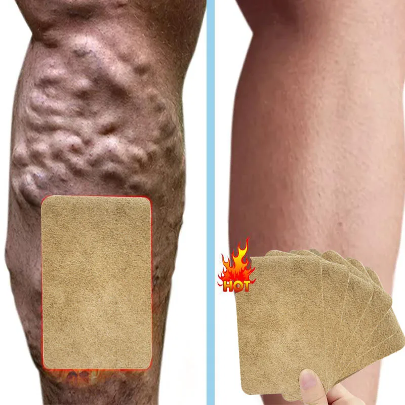 Varicose vein patch for treatment of varicose muscle vasculitis alleviating muscle swelling pain 6pcs=1bag
