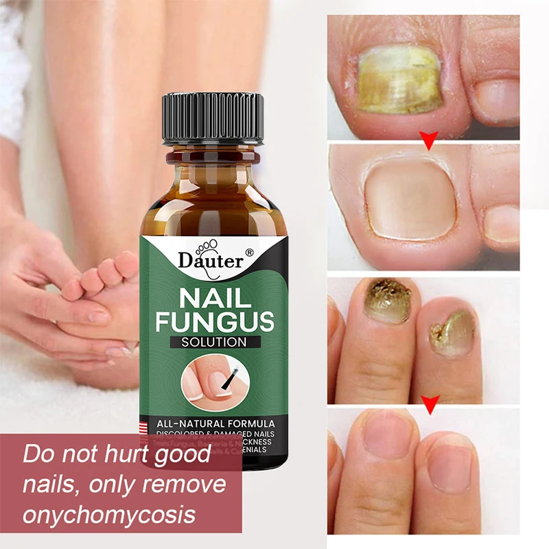 Nail Fungus Treatment Feet Care Essence Nails Foot Repair Toe Nail